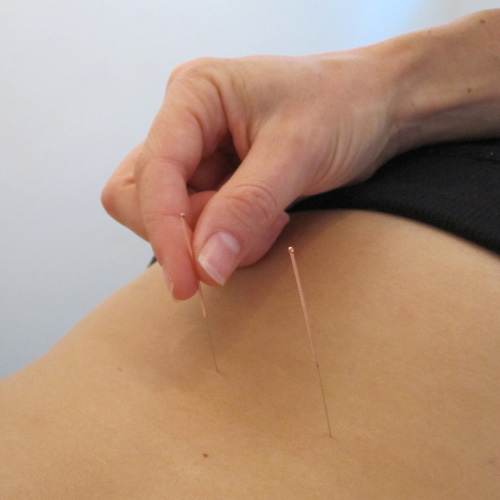 Acupuncture