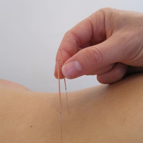 Acupuncture